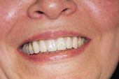 Gegenüber konventionellem Zahnersatz ist es mithilfe der Implantate möglich, eine festsitzende und gaumenfreie Brückenversorgung im Oberkiefer anzufertigen.