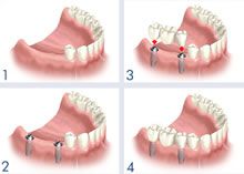 Zahn­implantate